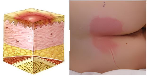 tratamento de Feridas por Pressão (Escaras)